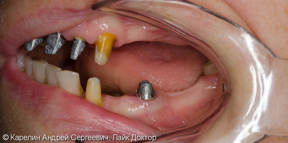 Полная реабилитация обеих челюстей с помощью металлокерамических коронок и съёмного протезирования - фото №11