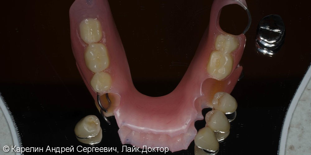 Полная реабилитация обеих челюстей с помощью металлокерамических коронок и съёмного протезирования - фото №13