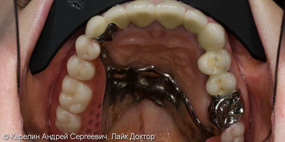 Полная реабилитация обеих челюстей с помощью металлокерамических коронок и съёмного протезирования - фото №14