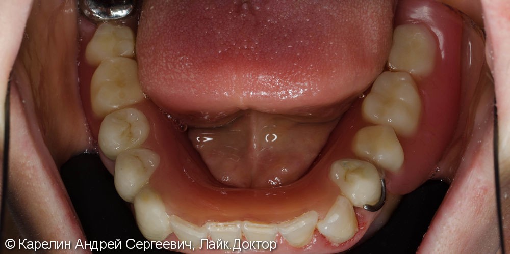 Полная реабилитация обеих челюстей с помощью металлокерамических коронок и съёмного протезирования - фото №15