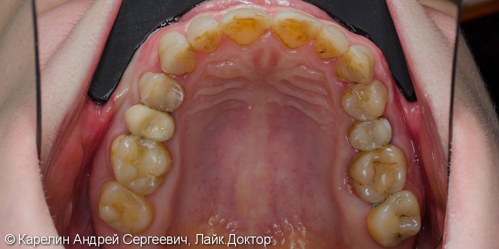 Восстановление эстетики в зоне улыбки керамическими винирами - фото №5