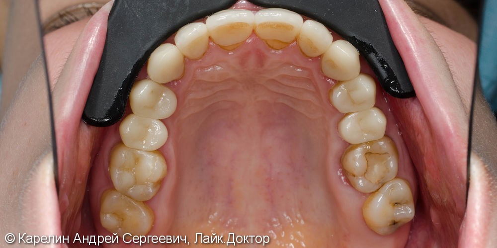 Восстановление эстетики в зоне улыбки керамическими винирами - фото №16