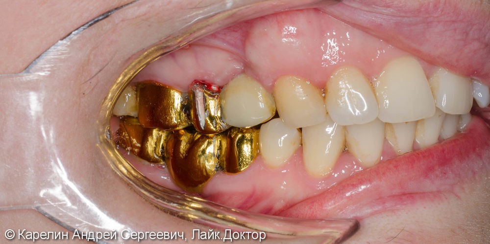 Восстановление утраченного зуба 1.4 с помощью Металлокерамической коронки на имплантате. - фото №1