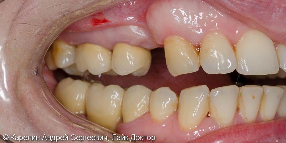Восстановление утраченного зуба 1.4 с помощью Металлокерамической коронки на имплантате. - фото №2