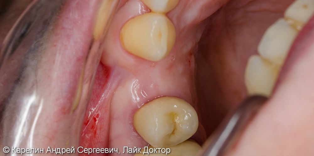 Восстановление утраченного зуба 1.4 с помощью Металлокерамической коронки на имплантате. - фото №3