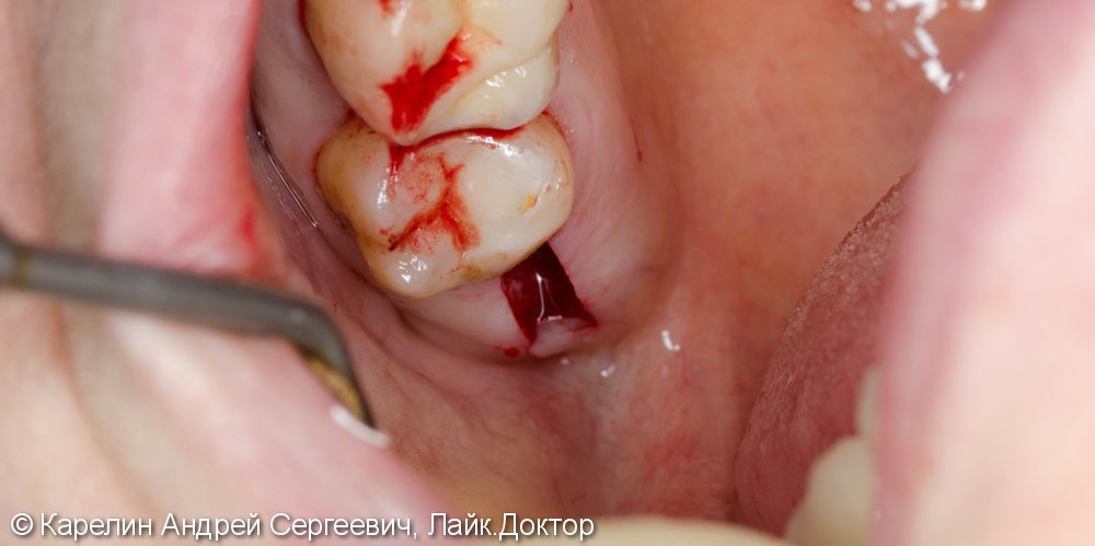 Восстановление утраченного зуба 1.4 с помощью Металлокерамической коронки на имплантате. - фото №5