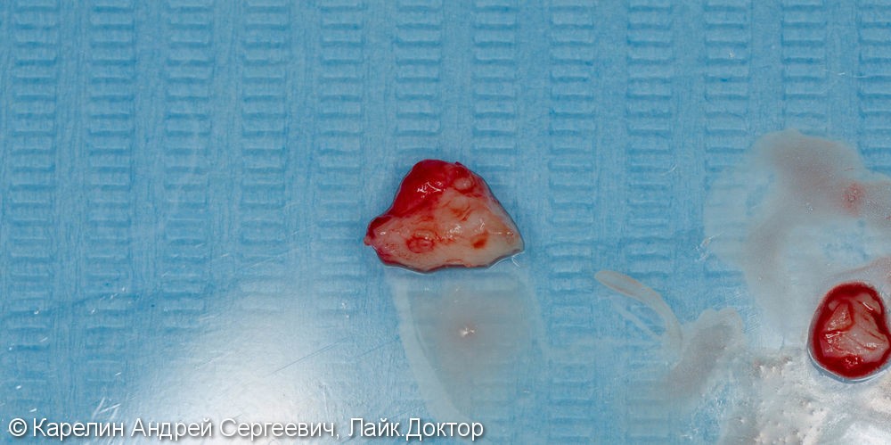 Восстановление утраченного зуба 1.4 с помощью Металлокерамической коронки на имплантате. - фото №6
