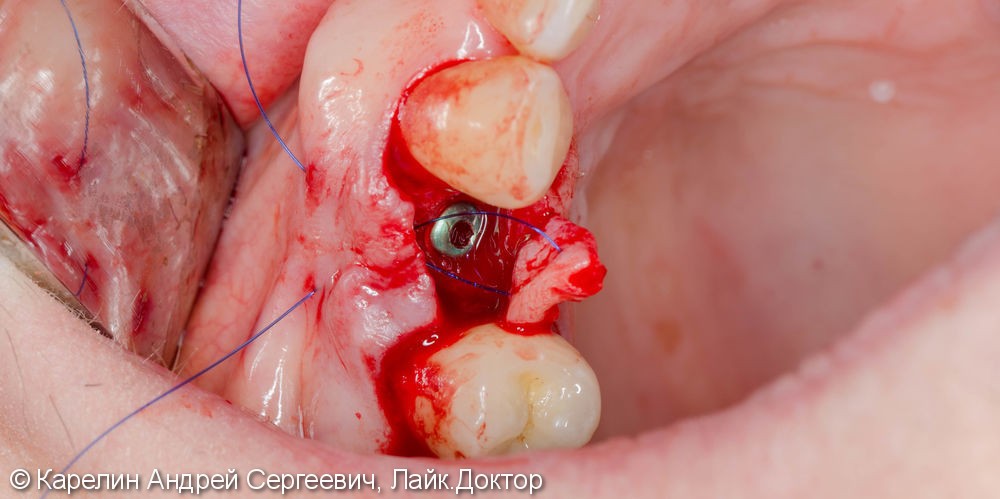 Восстановление утраченного зуба 1.4 с помощью Металлокерамической коронки на имплантате. - фото №7