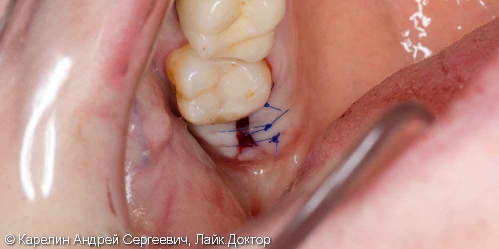 Восстановление утраченного зуба 1.4 с помощью Металлокерамической коронки на имплантате. - фото №8