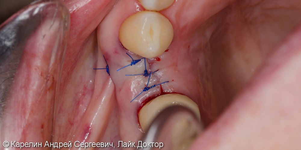 Восстановление утраченного зуба 1.4 с помощью Металлокерамической коронки на имплантате. - фото №9
