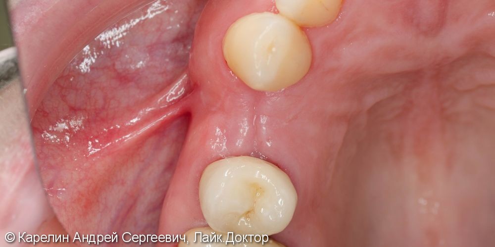 Восстановление утраченного зуба 1.4 с помощью Металлокерамической коронки на имплантате. - фото №10