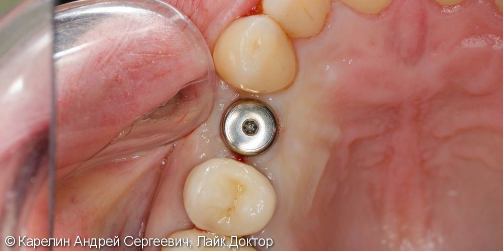 Восстановление утраченного зуба 1.4 с помощью Металлокерамической коронки на имплантате. - фото №11
