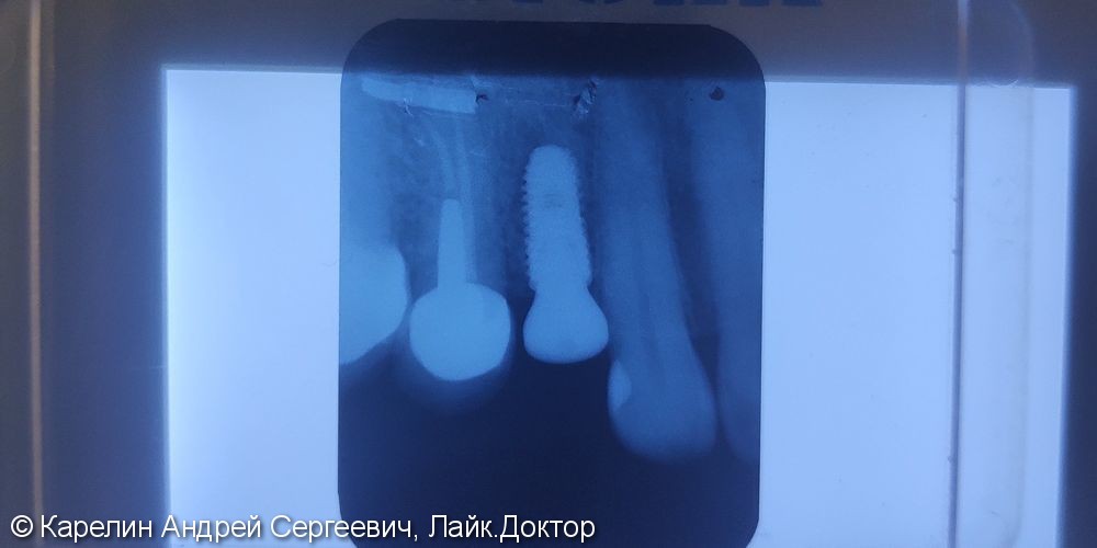 Восстановление утраченного зуба 1.4 с помощью Металлокерамической коронки на имплантате. - фото №12