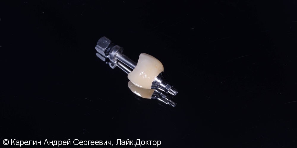 Восстановление утраченного зуба 1.4 с помощью Металлокерамической коронки на имплантате. - фото №13