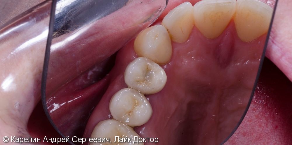 Восстановление утраченного зуба 1.4 с помощью Металлокерамической коронки на имплантате. - фото №14