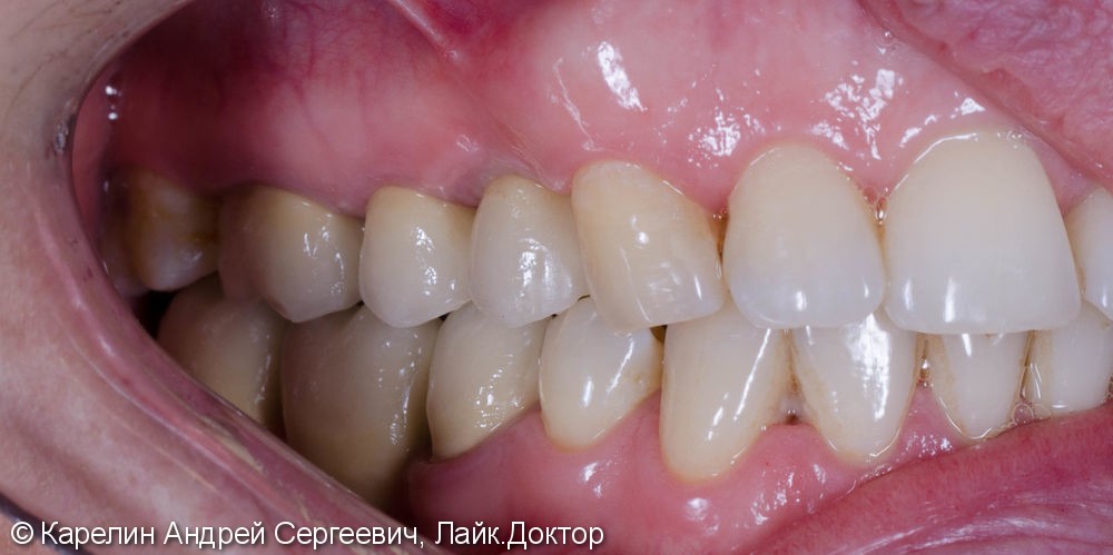 Восстановление утраченного зуба 1.4 с помощью Металлокерамической коронки на имплантате. - фото №15