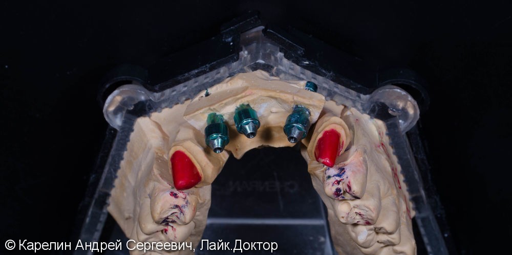 Сложное протезирование на имплантатах во фронтальном участке верхней челюсти. - фото №3