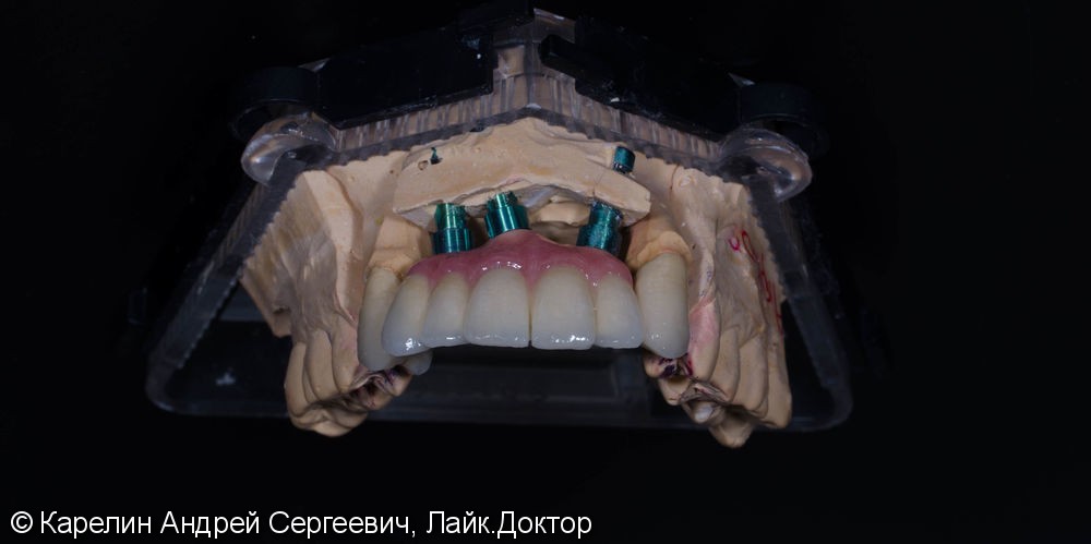 Сложное протезирование на имплантатах во фронтальном участке верхней челюсти. - фото №6