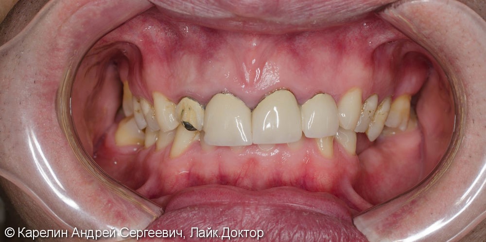 Подготовка фронтальных зубов к ортодонтическому лечению - фото №2