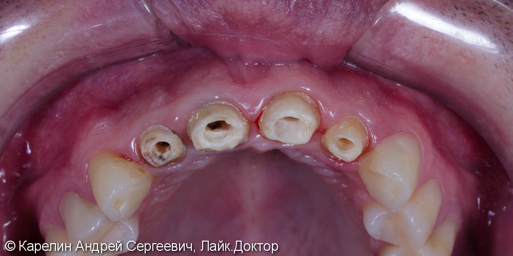 Подготовка фронтальных зубов к ортодонтическому лечению - фото №3