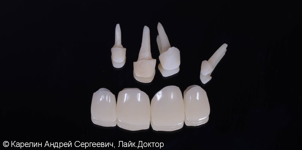 Подготовка фронтальных зубов к ортодонтическому лечению - фото №5