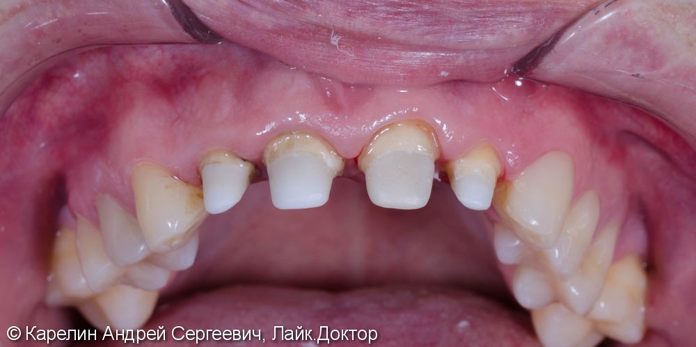 Подготовка фронтальных зубов к ортодонтическому лечению - фото №6