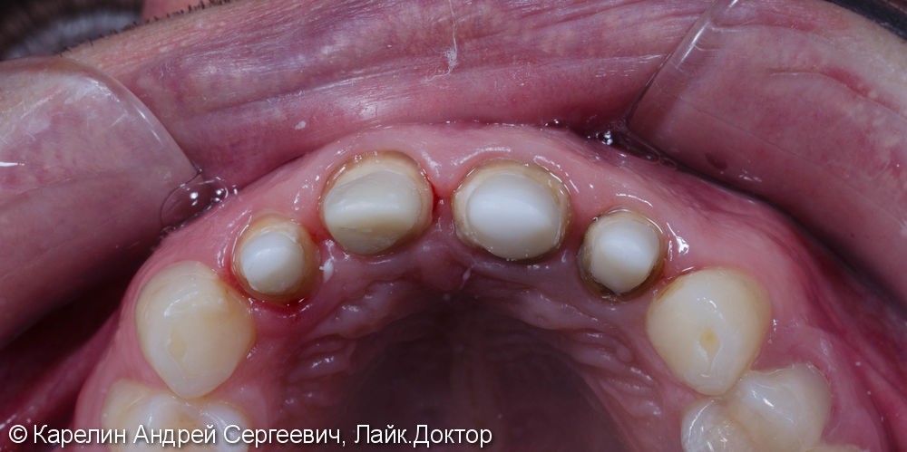 Подготовка фронтальных зубов к ортодонтическому лечению - фото №7