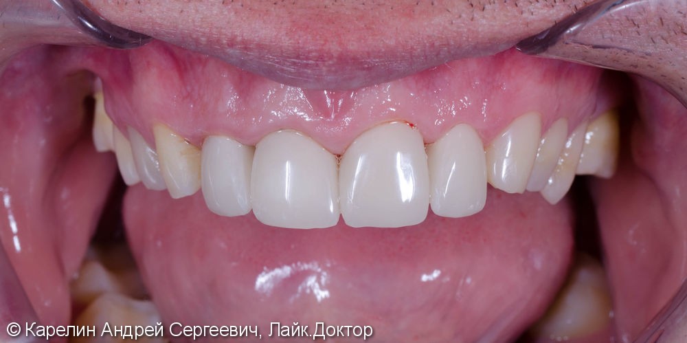 Подготовка фронтальных зубов к ортодонтическому лечению - фото №8