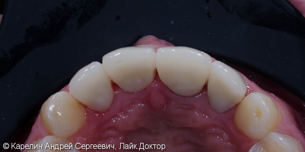 Подготовка фронтальных зубов к ортодонтическому лечению - фото №9