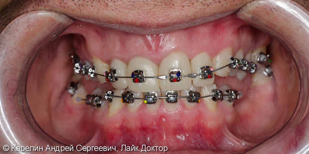 Подготовка фронтальных зубов к ортодонтическому лечению - фото №10
