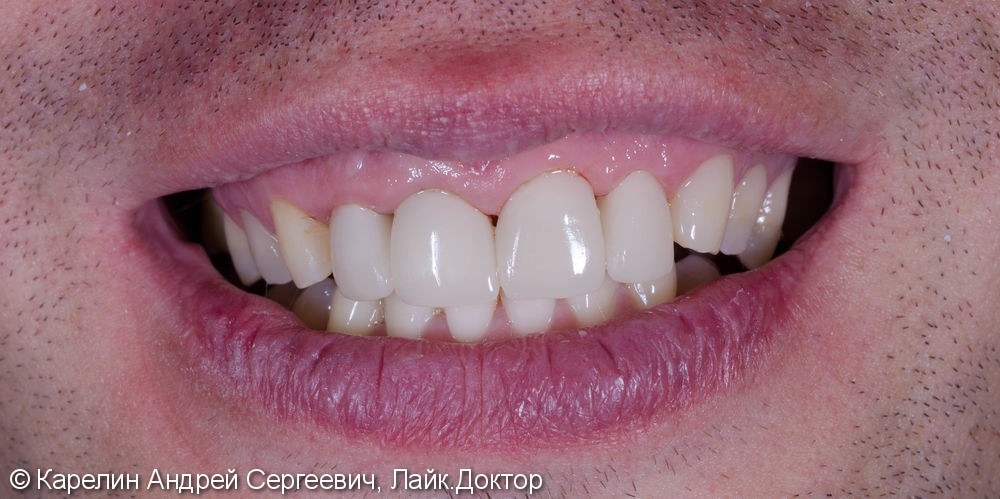 Подготовка фронтальных зубов к ортодонтическому лечению - фото №11
