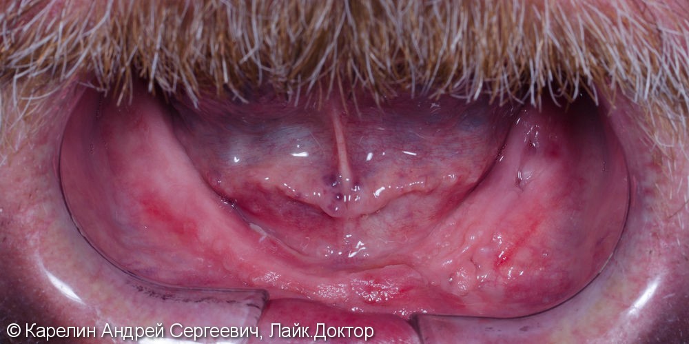 Лечение пациента с полной вторичной адентией обеих челюстей. - фото №3