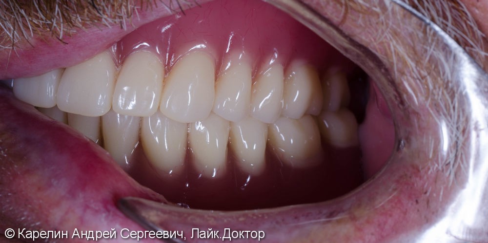 Лечение пациента с полной вторичной адентией обеих челюстей. - фото №8