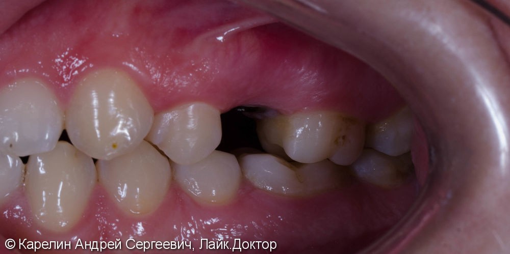 Восстановление зуба 2.5 с помощью имплантата. - фото №1