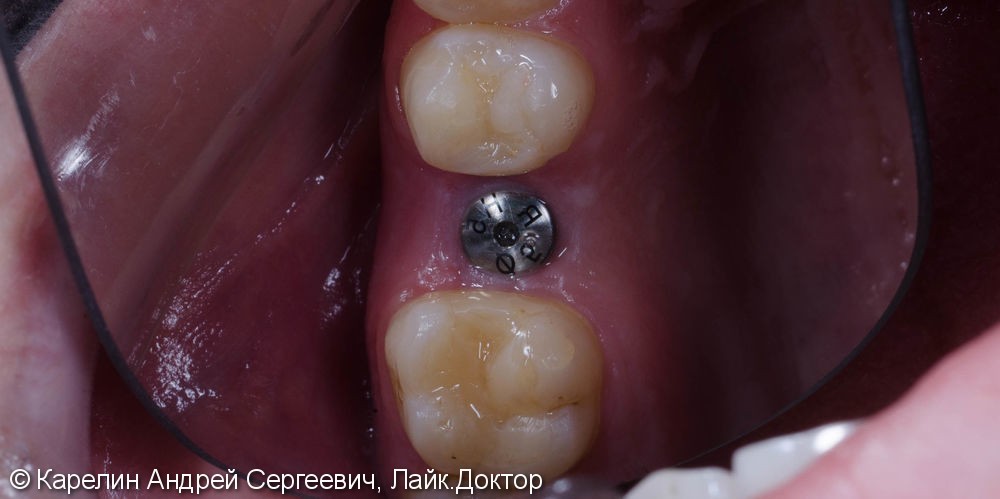 Восстановление зуба 2.5 с помощью имплантата. - фото №2