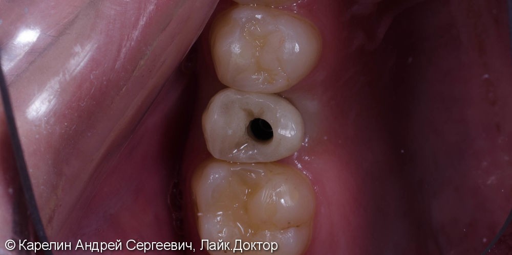 Восстановление зуба 2.5 с помощью имплантата. - фото №3