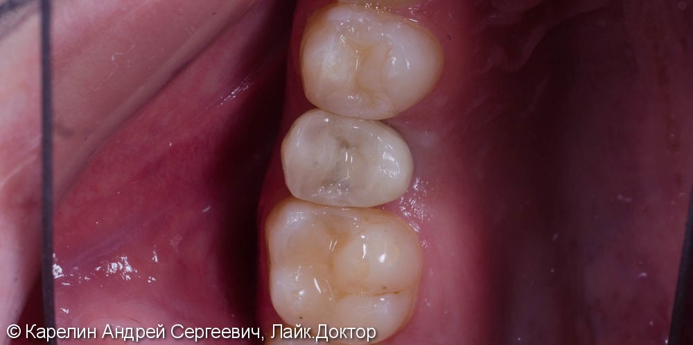Восстановление зуба 2.5 с помощью имплантата. - фото №4