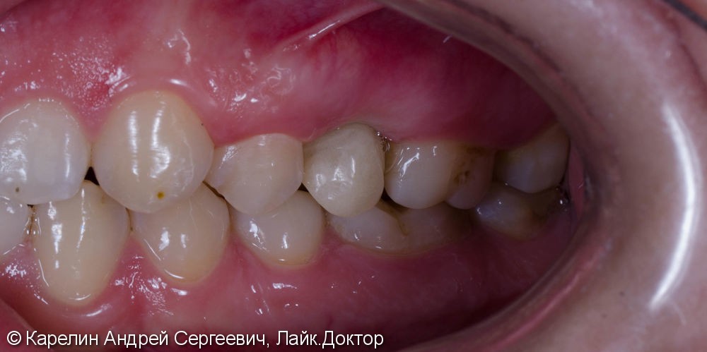 Восстановление зуба 2.5 с помощью имплантата. - фото №5