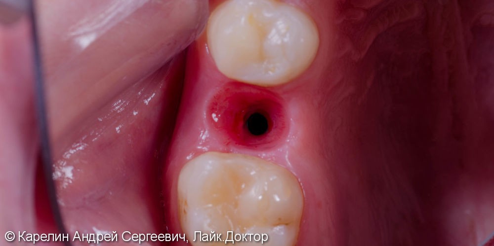 Восстановление зуба 2.5 с помощью имплантата. - фото №6