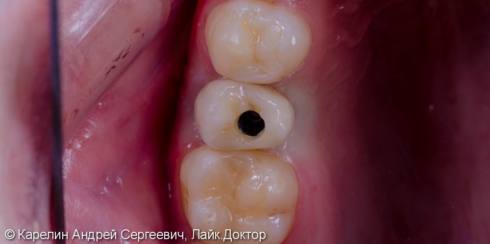Восстановление зуба 2.5 с помощью имплантата. - фото №8