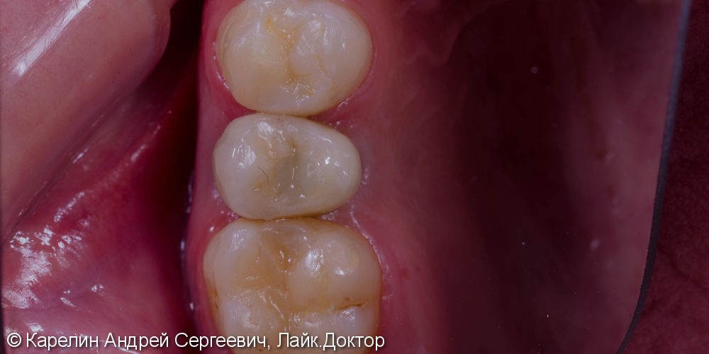 Восстановление зуба 2.5 с помощью имплантата. - фото №9