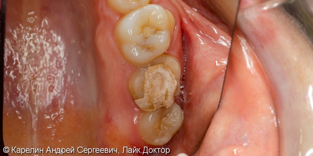 Восстановление сильно разрушенного зуба вкладкой OVERLAY после эндодонтии. - фото №1