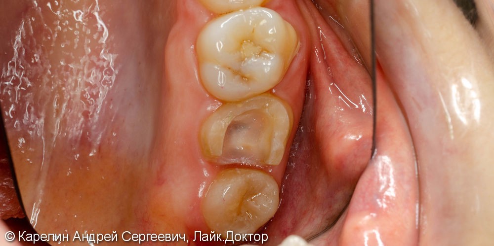 Восстановление сильно разрушенного зуба вкладкой OVERLAY после эндодонтии. - фото №2