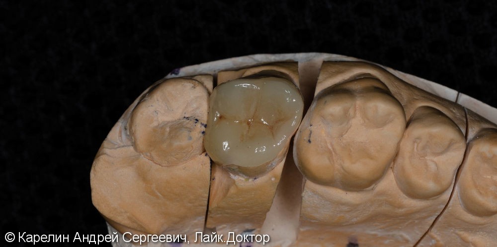 Восстановление сильно разрушенного зуба вкладкой OVERLAY после эндодонтии. - фото №3