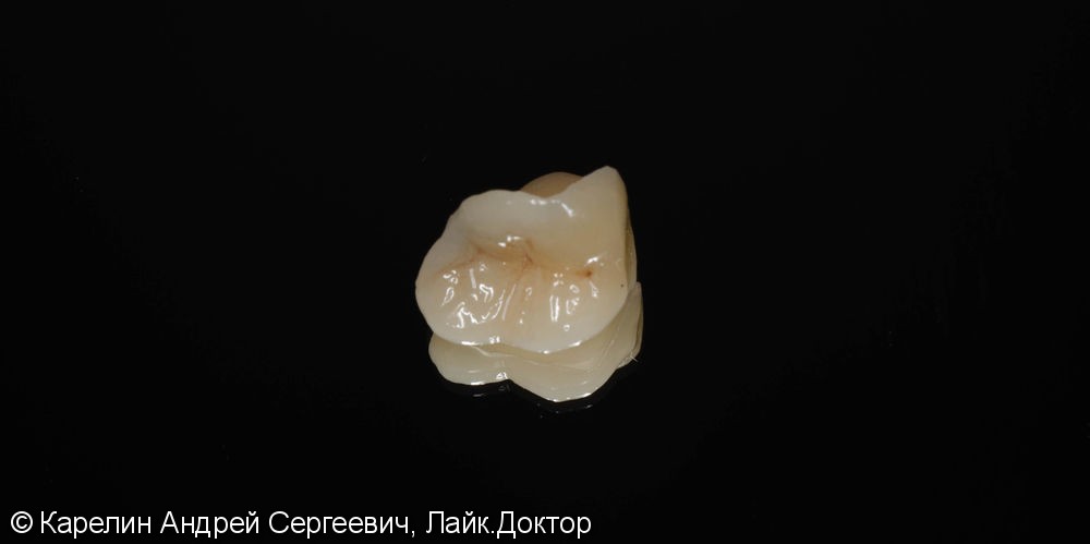 Восстановление сильно разрушенного зуба вкладкой OVERLAY после эндодонтии. - фото №4