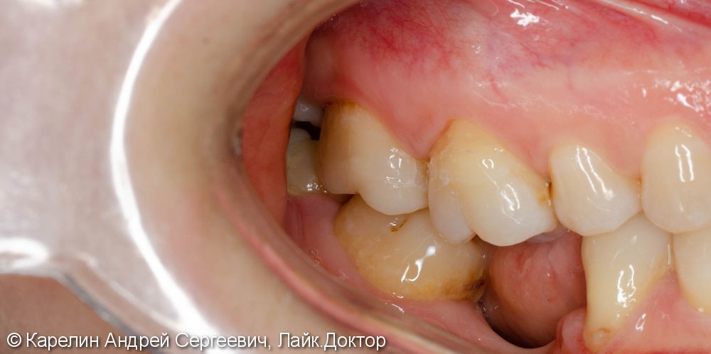 Восстановление сильно разрушенного зуба вкладкой OVERLAY после эндодонтии. - фото №6