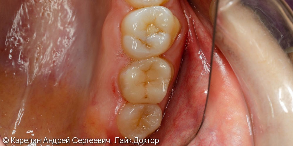 Восстановление сильно разрушенного зуба вкладкой OVERLAY после эндодонтии. - фото №7