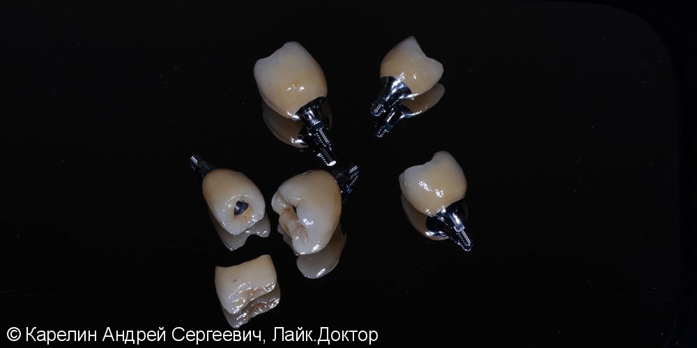 Восстановление отсутствующих зубов с помощью имплантатов. - фото №3