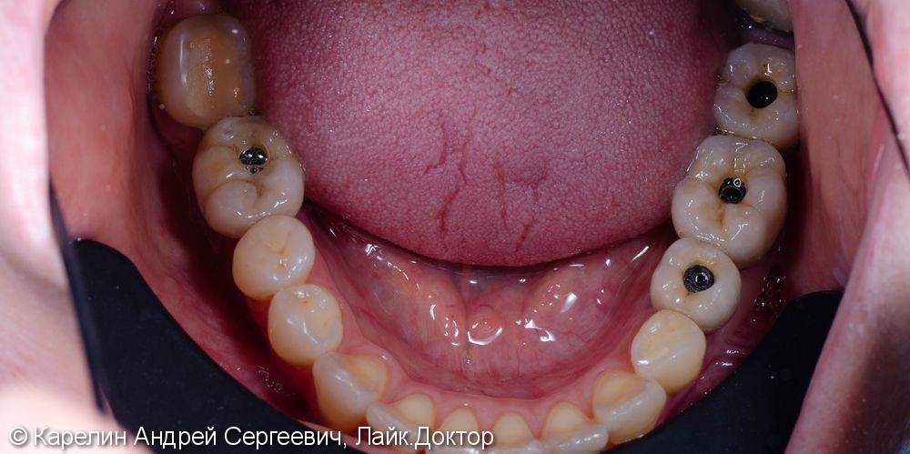 Восстановление отсутствующих зубов с помощью имплантатов. - фото №9