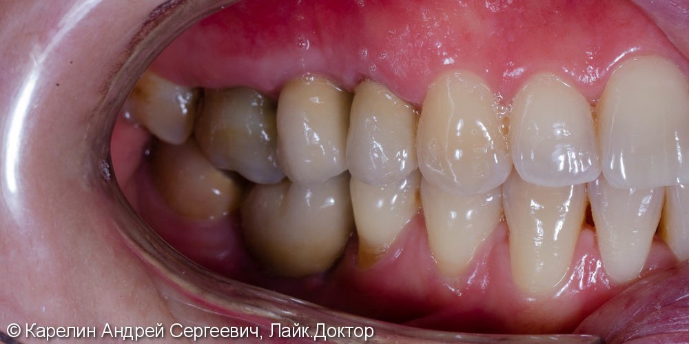 Восстановление отсутствующих зубов с помощью имплантатов. - фото №10